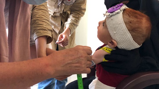 Ett undernärt barn i Syrien.