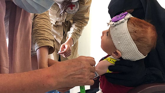 Ett undernärt barn i Syrien.