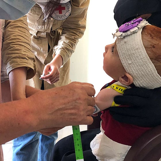 Ett undernärt barn i Syrien.