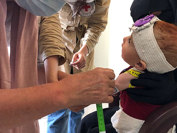 Ett undernärt barn i Syrien.